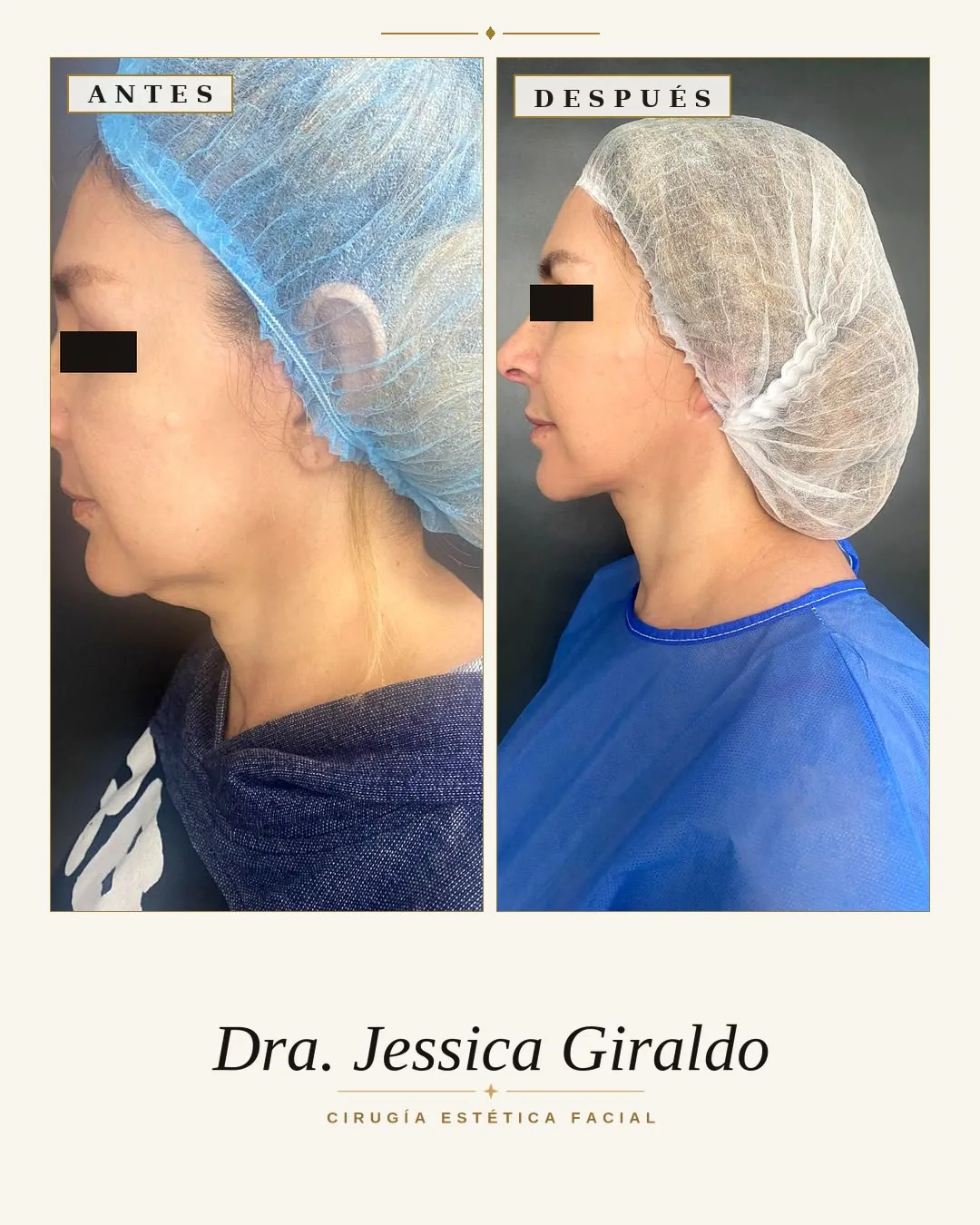 Perfil izquierdo de una paciente antes y después del procedimiento